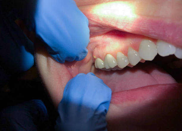 Best Emergency Dental Care for Broken or Chipped Teeth in Buchanan, NY